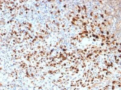 Immunohistochemistry-Paraffin: Herpes Simplex Virus 1 Antibody [NBP3-07318] - Formalin-fixed, paraffin-embedded human Cervix stained with Herpes Simplex Virus 1 Rabbit Polyclonal Antibody.